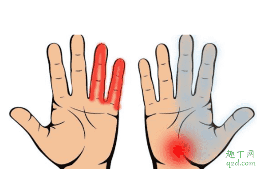 經(jīng)常手腳麻為什么原因 經(jīng)常手麻的人有可能是什么病3