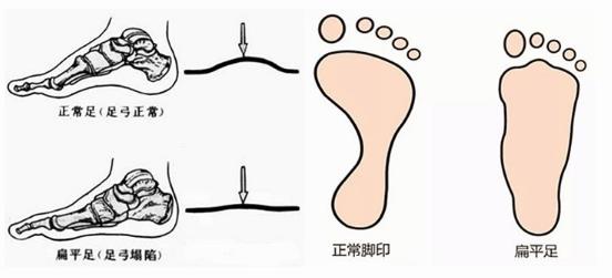 扁平足能跑步嗎？扁平足跑步有什么危害？