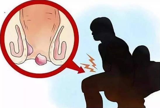 痔瘡是怎么引起的？痔瘡的最佳簡單預防方法